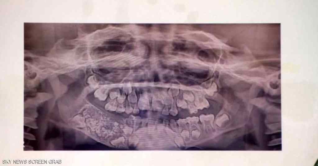 اقتلاع 526 سناً وضرساً من فم&nbsp;طفل