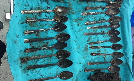 ملاعق في بطن مريض