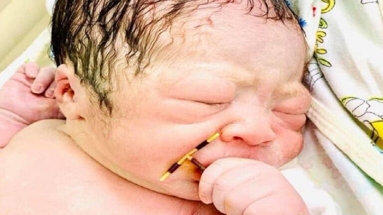 حدث استثنائي.. وُلِد وبيده لولب منع الحمل الذي استخدمته&nbsp;أمه